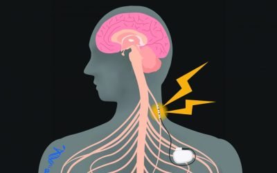 Bye-bye Opioids? Introducing Electroceuticals