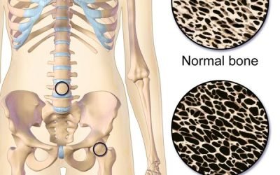 A Bone to Pick With Osteoporosis